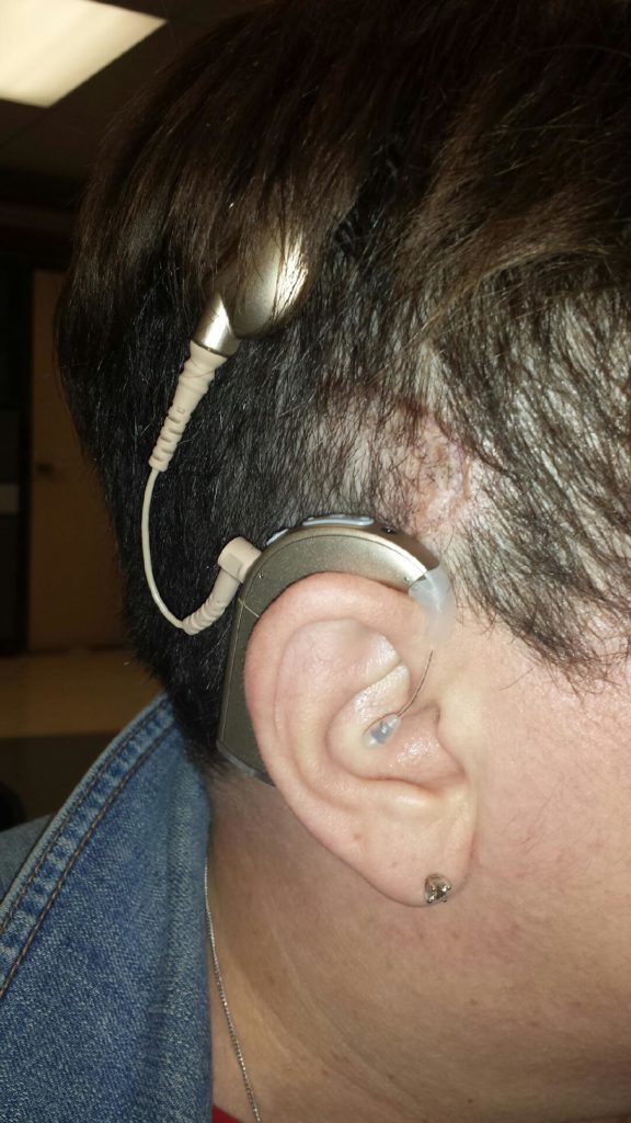 Michelle's cochlear implant