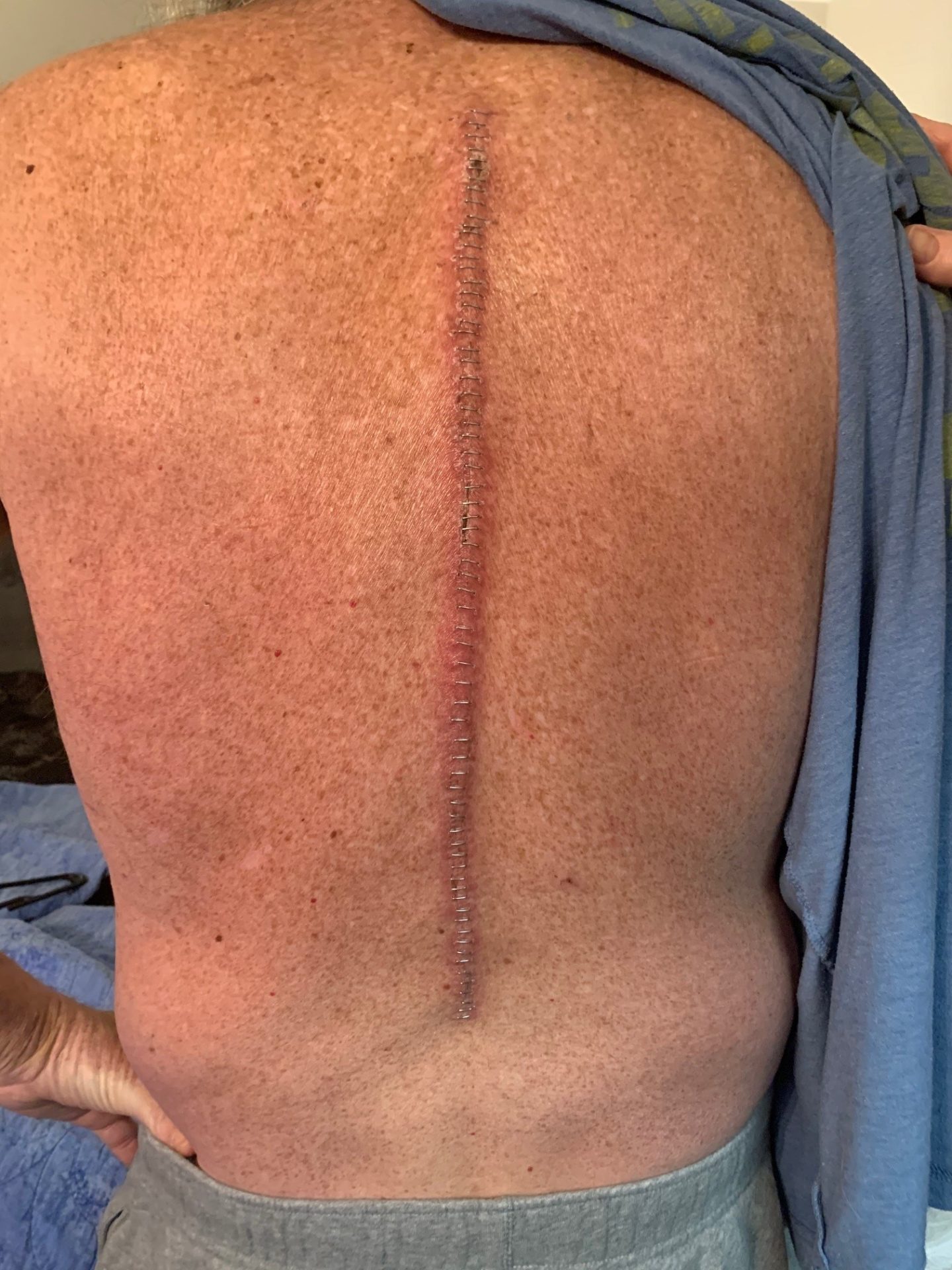 Ron's back with staples along his spine