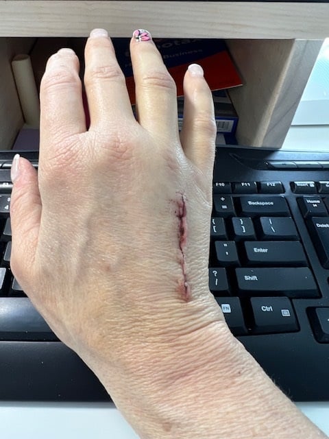 Kristin Couldhard's injured hand.